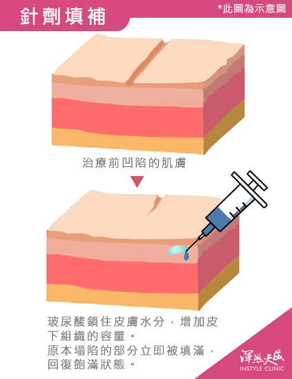 針劑填補 針劑填補